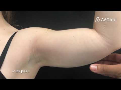 YouTube video about: What is the difference between j plasma and vaser lipo?