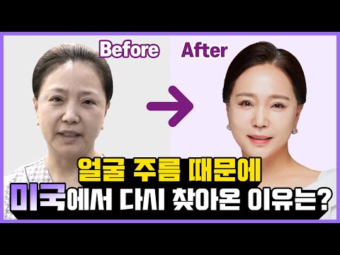 #안면거상 후 2개월 경과 되찾은 청춘