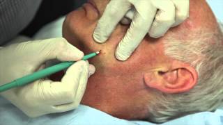 How to remove facial warts using Cautery