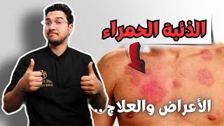 علاج الذئبة الحمراء | أعراض الذئبة الحمراء - Systemic Lupus Erythematosus