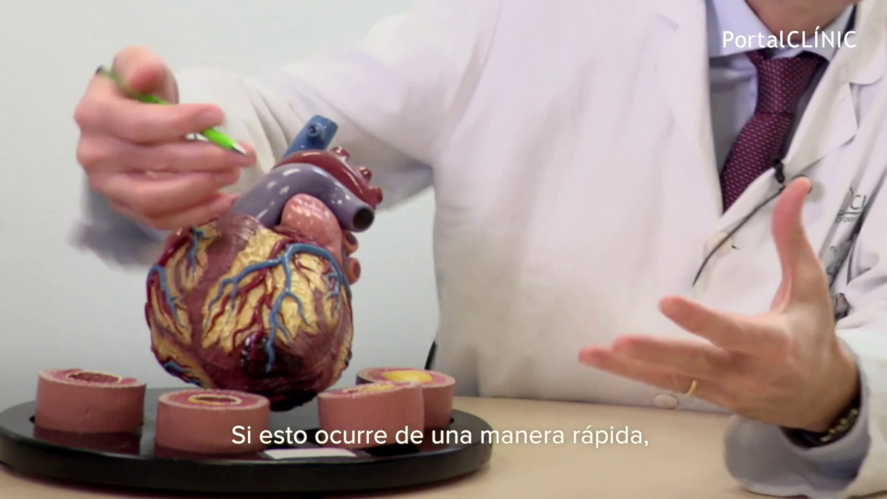 Cardiopatía Isquémica | PortalCLÍNIC