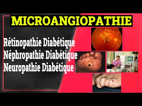Complications Chroniques du Diabète: Microangiopathie Diabétique | Endocrinologie Medicale