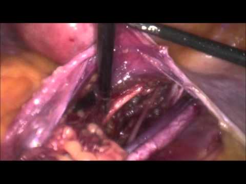 marSeal5 IQ – Pelvic lymphadenectomy