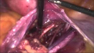 marSeal5 IQ | Pelvic lymphadenectomy