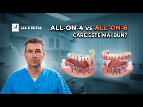 Implant dentar All-on-4 și All-on-6: Etape, Costuri, Avantaje - LLL Dental