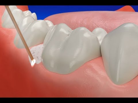 How gum disease treatment laser works