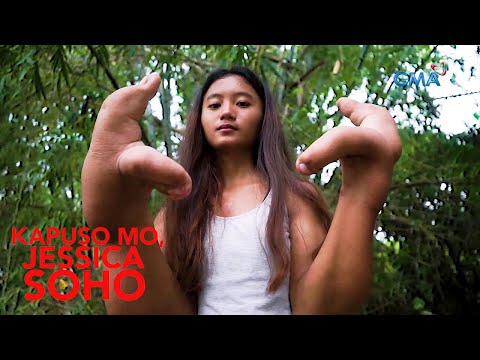 Kapuso Mo, Jessica Soho: MGA BRASO AT KAMAY NG DALAGA MULA PANGASINAN, BAKIT LUMOBO?