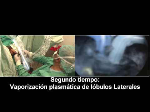Eine Größe der Prostata in einem gesunden männlichen Steigt der Druck aufgrund von Prostatitis