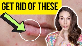 HOW TO GET RID OF LIP PIMPLES FAST | Dermatologist