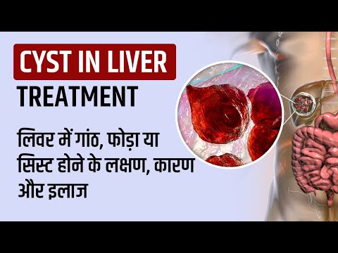 Cyst in Liver in Hindi, Symptoms, Treatment, Symptoms, Causes and Treatment of Lump, Abscess or C...