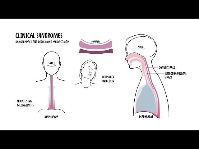 Deep Neck Infection Causes, specific syndromes and symptoms, Complications & Treatment