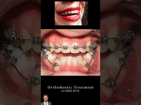 OPEN Bite Treatment! #orthodontist #smiledesigndental