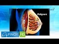 Pinoy MD Ano Ang Sanhi Ng Pagkakaroon Ng Bukol Sa Dibdib