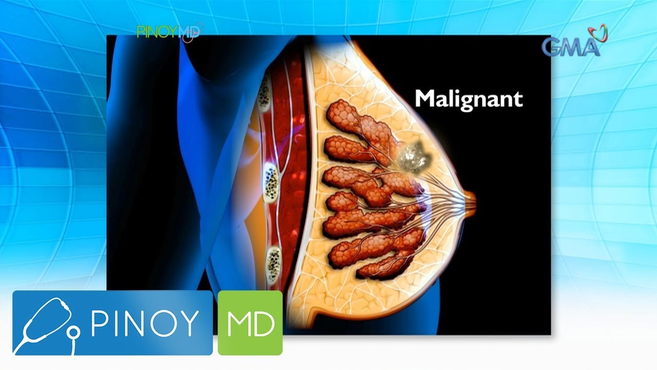 Pinoy MD: Ano ang sanhi ng pagkakaroon ng bukol sa dibdib