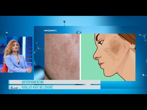 Hipokrati – Si të hiqni njollat kafe dhe shenjat në fytyrë, flet dermatologia