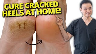 7 Cracked Heel Home Remedies That REALLY Work!
