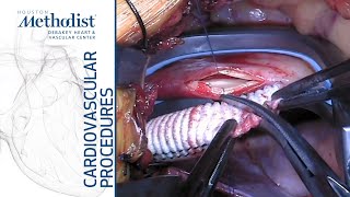 Download Lagu Aorta to Right Carotid Bypass (A. Lumsden, MD, M. Ramchandani, MD, E. Andraos, MD, M. Zubair, MD) Thumbnail