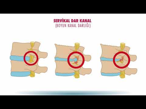 Servikal dar kanal (boyun kanal darlığı) neden olur? - Doç. Dr. Onur Yaman (Omurga Cerrahisi Uzmanı)