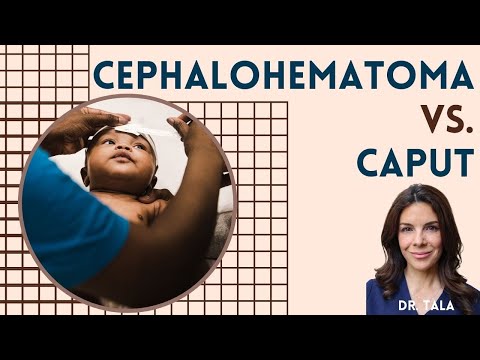 Caput Succedaneum vs Cephalohematoma - NICU Nuggets - Tala Talks NICU