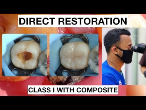 Step by Step Layering Composite | Simple Way