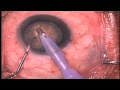 Cataract Surgery