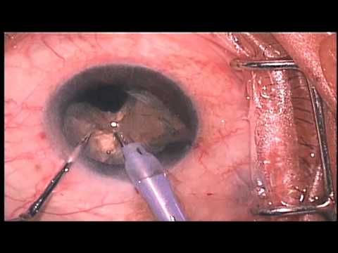 Cataract Surgery: Phacoemulsification