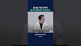 당뇨발, 작은 상처 방치했다간 발가락 절단까지 간다?
