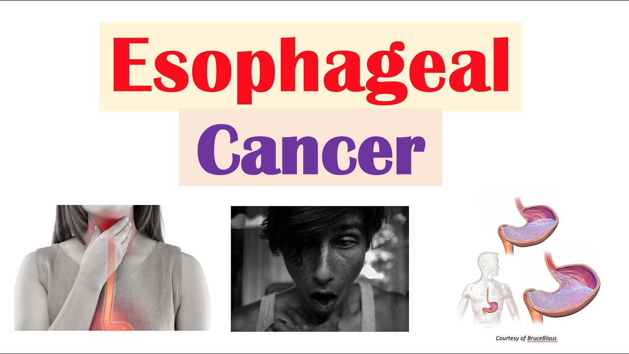 Esophageal Cancer | Risk Factors, Pathogenesis, Signs and Symptoms, Diagnosis, Treatment