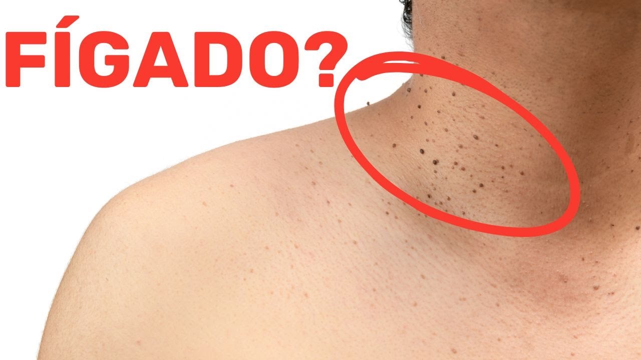 Esta mudança na pele significa que seu fígado está em perigo!