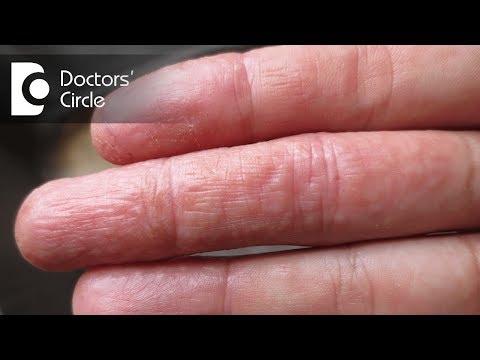 Che psoriasi lichit Cura di psoriasi in Rostov su Don in ospedale