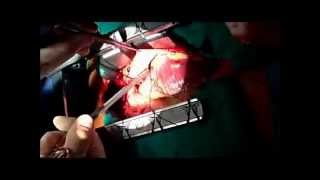 High Risk Off Pump Coronary Artery Bypass Graft