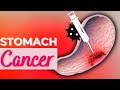 Stomach Cancer Causes Signs And Symptoms Diagnosis And Treatment