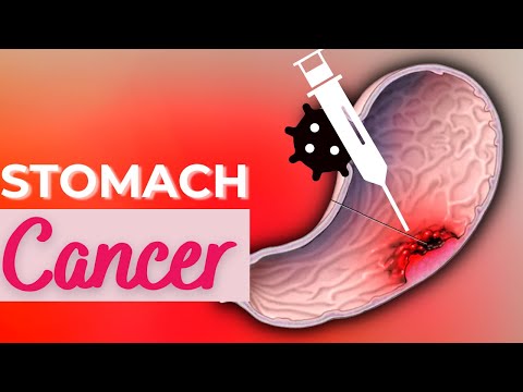 Stomach Cancer, Causes, Signs and Symptoms, Diagnosis and Treatment.