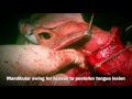 Hemiglossectomy with mandibular swing approach reconstruction by ALT flap Dr Amit Dhawan