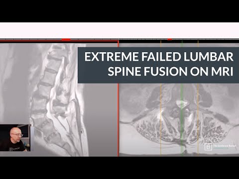 Extreme Failed Lumbar Fusion on MRI