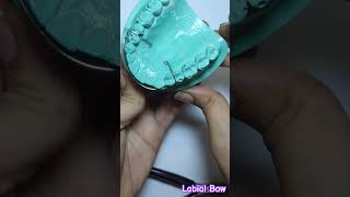 Download lagu Labial Bow #shorts #orthodontics #teeth #shortvideo #shortsfeed #labialbow mp3