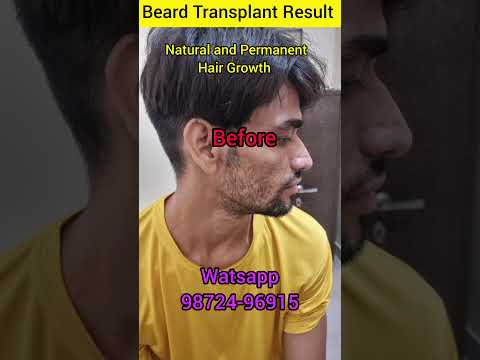 Beard hair growth || How to Regrow Hair 🔥#hair...