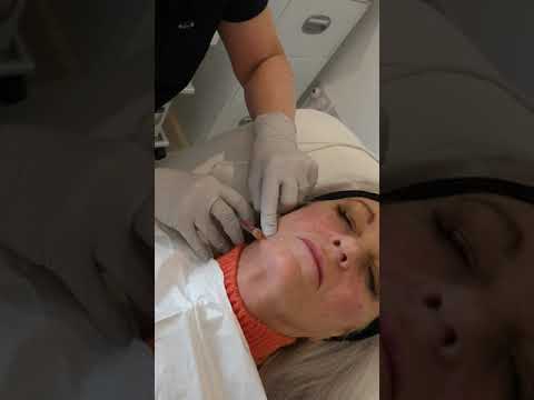 Demonstration: Treating Marionette lines with a Cannula