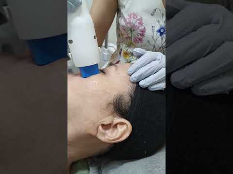 Chin Filler Transformation | Sharper & Balanced Side Profile