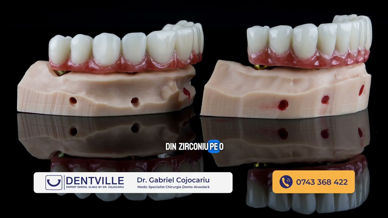 <div style="text-align: left; white-space: normal; overflow: hidden; display: -webkit-box; -webkit-line-clamp: 2; -webkit-box-orient: vertical; line-height: 1.3em;">Afla din ce materiale se fabrica dantura fixa pe implanturi și care e cea mai buna varianta |</div>