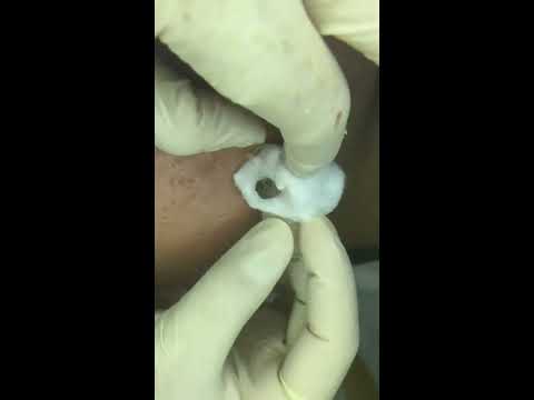 Có ai có sở thích xem nặn mụn k ! nhìn đã sướng con mắt :v