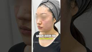 울쎄라+리쥬란 시술 직후