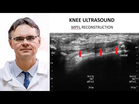 Knee Ultrasound – MPFL Injury and Patellar Instability