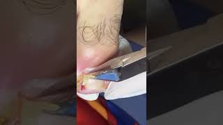 Vídeo de Unha Encravada