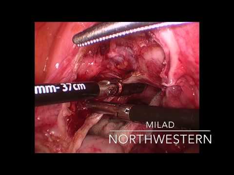 Laparoscopic Hysterectomy