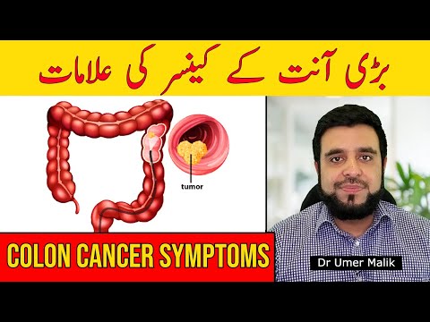 Bari Aant Ka Cancer Ki Alamat | Colon Cancer Symptoms, Signs of Colon Cancer, Bowel Cancer Ki Alamat