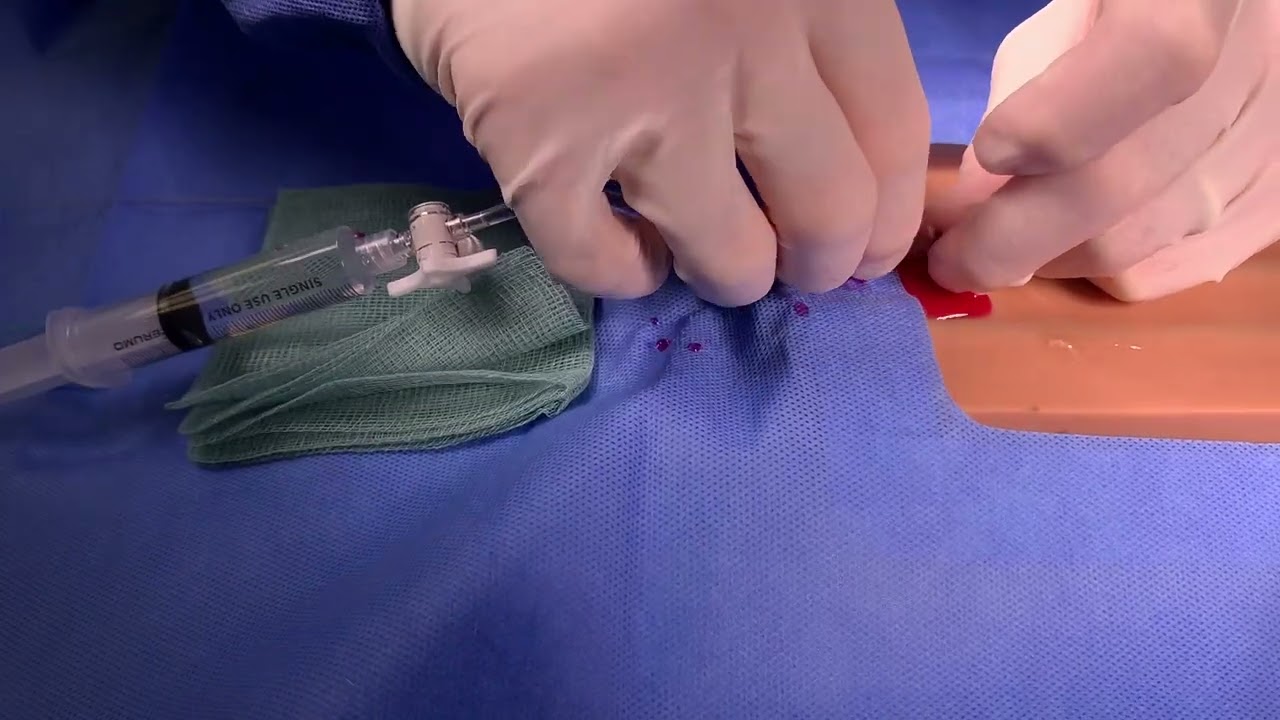 Difficult intravenous access: the Vygon Leadercath as an introducer for wider bore cannula   HD 1080