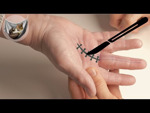 Operation bei Schnappfinger? - kurze Erklärung