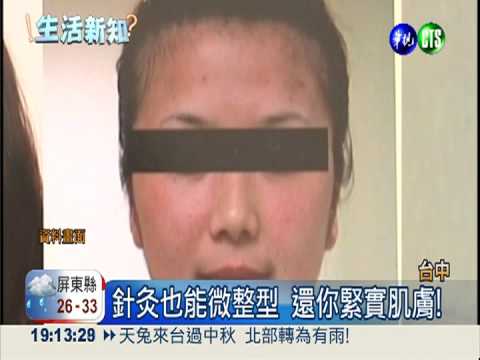 針灸也能微整型 還你緊實肌膚!