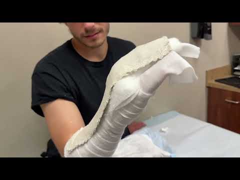 Radial Gutter Splint  2 Slabs SA (Plaster)